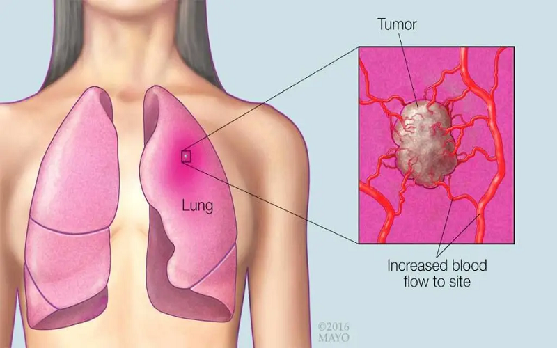 Lung Cancer: Causes, Symptoms, Treatment, and Prevention