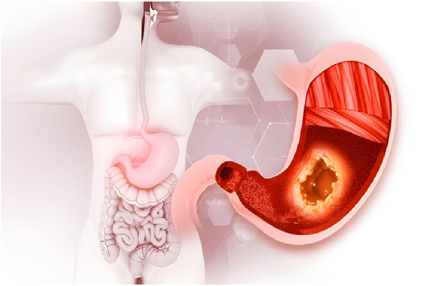 Causes Of Stomach Ulcers: Symptoms And  Treatments